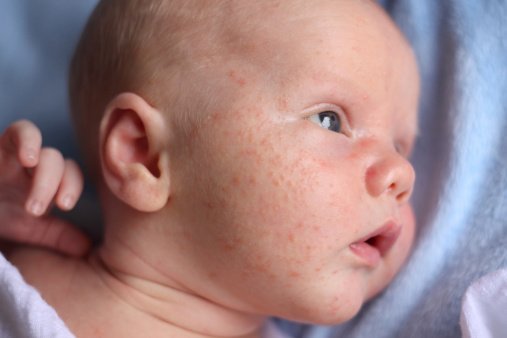 El calor aumenta las consultas pediátricas por sudamina - miliaira bebe 1 Bebé con sudamina.