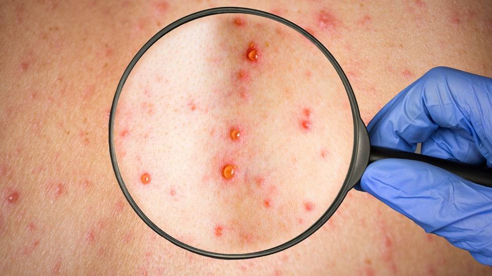 La OMS declara la emergencia internacional por la viruela del mono - 1652816534751 Síntomas de la viruela del mono en humanos.