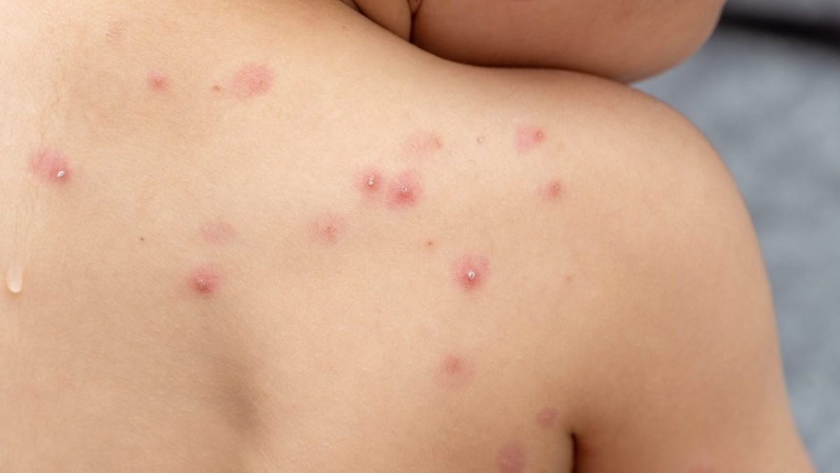 91 casos activos de Viruela del Mono en Málaga
