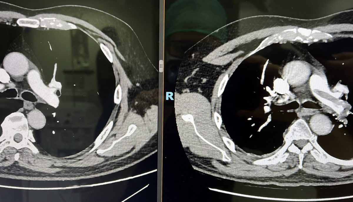 Quirónsalud Marbella desarrolla protocolos para tratar a pacientes con tromboembolismo pulmonar grave - posterior y previo a tratamiento Quirónsalud Marbella desarrolla protocolos para tratar a pacientes con tromboembolismo pulmonar grave - posterior y previo a tratamiento