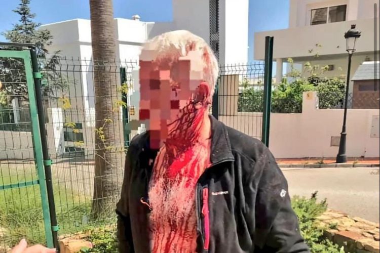 Indignación por el caso de los okupas de Manilva: "Si no los detienen, los echaremos nosotros el jueves" - Agresion Jesus Navarro 750x500 1 Mike, tras la brutal agresión por los okupas de su vivienda. / Jesús Navarro