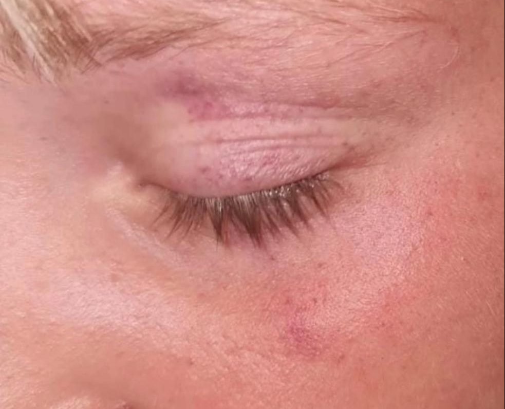 Un niño de 11 años recibe una brutal paliza en Marbella en el Campo de Fútbol Los Compadres - WhatsApp Image 2023 07 03 at 13.46.43 e1688384962112 Un niño de 11 años recibe una brutal paliza en Marbella en el Campo de Fútbol Los Compadres - WhatsApp Image 2023 07 03 at 13.46.43 e1688384962112