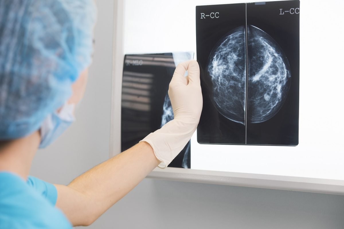 Detectar el cáncer de mama a tiempo: En Vithas Xanit Estepona poseen las técnicas más avanzadas - Mamografia vs autoexamen 1 Mamografía