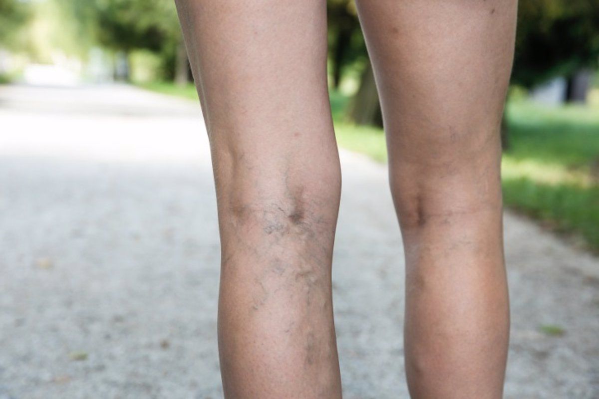 Eliminar varices en verano y sin cirugía, la novedosa técnica de IVEI Clínica Vascular Marbella - WhatsApp Image 2024 06 28 at 15.22.36 Eliminar varices en verano y sin cirugía, la novedosa técnica de IVEI Clínica Vascular Marbella - WhatsApp Image 2024 06 28 at 15.22.36