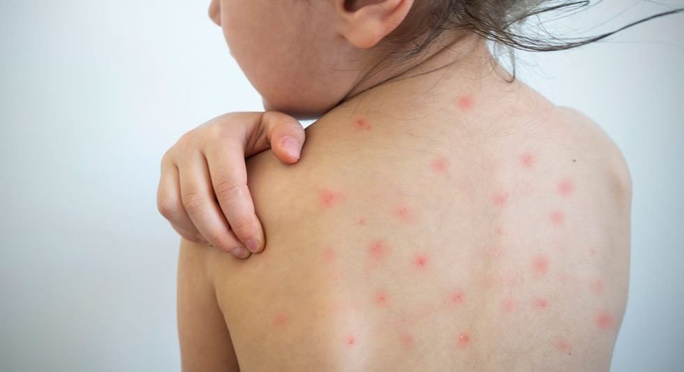Aumento de casos de sarampión en Andalucía: adelantada la segunda dosis de la vacuna - measles su19 e1738919185296 Aumento de casos de sarampión en Andalucía: adelantada la segunda dosis de la vacuna - measles su19 e1738919185296