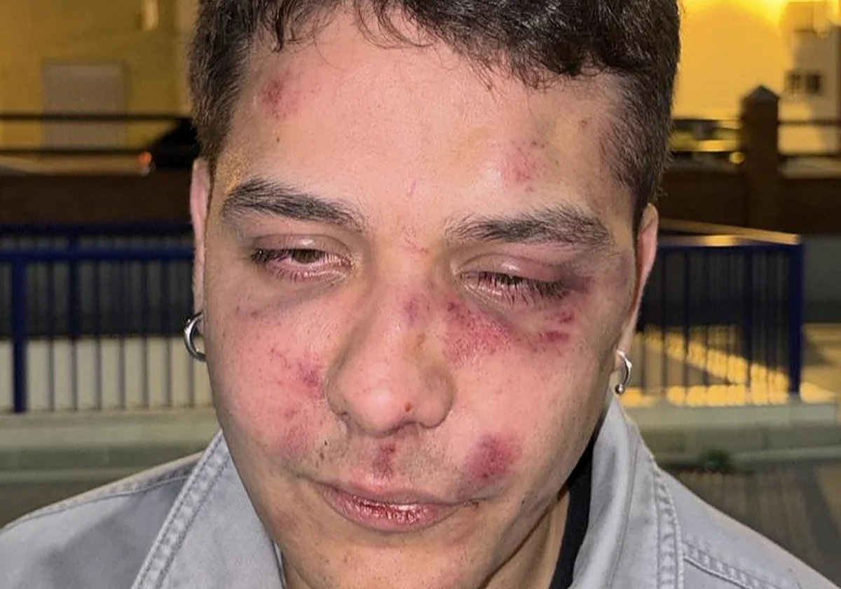 Brutal agresión a un joven a la salida de una discoteca en Málaga: “Difundid mi rostro para que no se olvide lo que hace el odio” - 3ab29ce224bb18ff77ea0947c1a3a25433fa98cd agresión