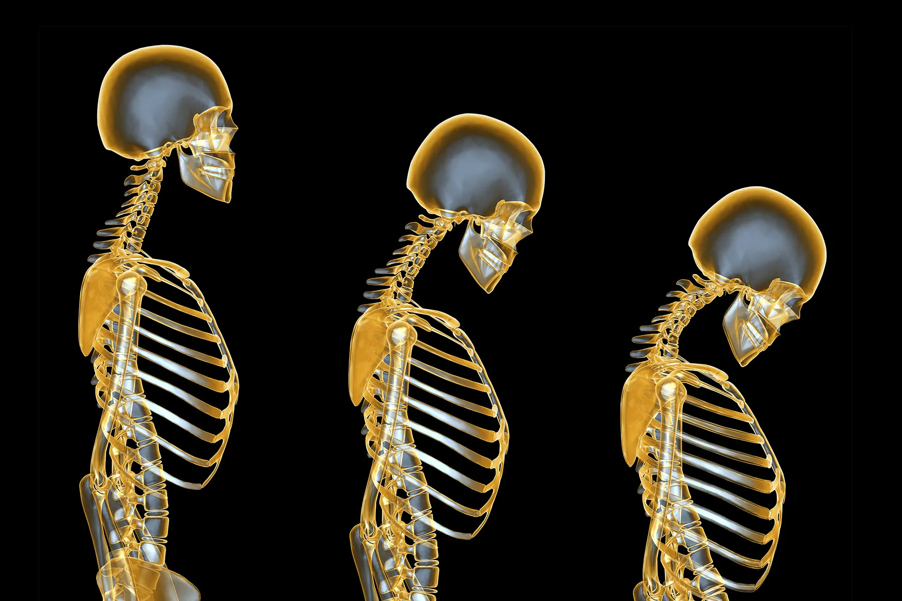La osteoporosis, la enfermedad silenciosa que no avisa hasta la fractura - osteoporosis osteoporosis